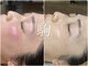 コマ(KOMA)の写真/【剥離・ダウンタイムなし】繰り返すニキビ・毛穴・くすみに。肌を育てる優しいハーブピーリング