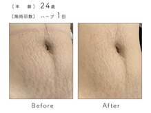 ルナスーリヤ 表参道店/ハーブピーリング