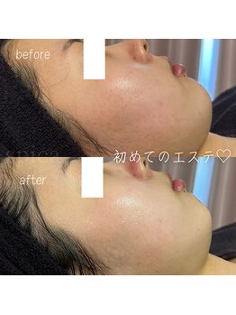 スピカ(Spica)/初めてのエステでご来店☆