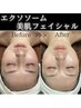 【潤い陶器肌】最新エイジングケアエクソソーム導入マッサージ付き60分