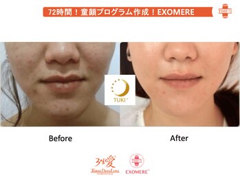 ツキ(TUKI+)/剥けない・ダウンタイム無し