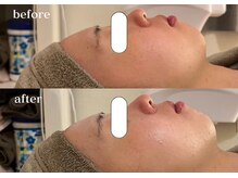 リスタ(RSTA)/【BEFORE/AFTER】