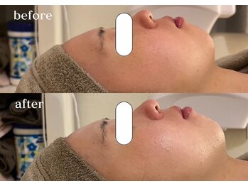 リスタ(RSTA)/【BEFORE/AFTER】