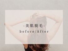 ヴィキ 北千住(VIKI)/脱毛　before/After