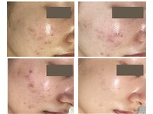 レクラ バイ ドクターエイチ(L'ECLAT by Doctor.H)/ハーブピーリング