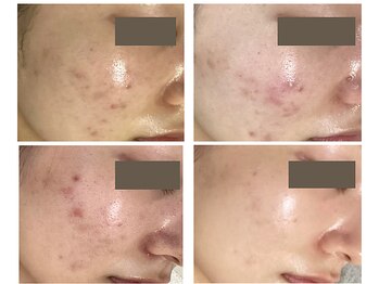 レクラ バイ ドクターエイチ(L'ECLAT by Doctor.H)/ハーブピーリング