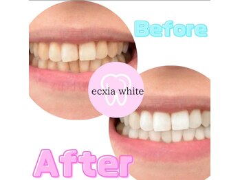 エクシアホワイトニング 大宮東口店/ホワイトニングビフォーアフター