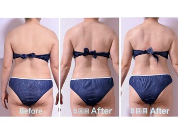 サロン アモル(salon amor)の写真/【本物のインディバでプロが叶える理想の美◇】脂肪燃焼し基礎代謝をUP！周りが羨む理想美ボディへ♪