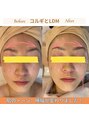 ジーンバイピエル 中野店(gene by PIEL)&nbsp;ララピール、コルギ、LDM各1回目の様子です。