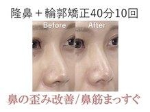 ラプリ 梅田店(Raplit)/隆鼻＋輪郭矯正40分10回