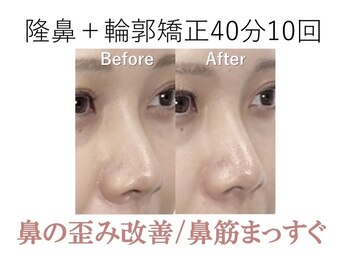 ラプリ 梅田店(Raplit)/隆鼻＋輪郭矯正40分10回