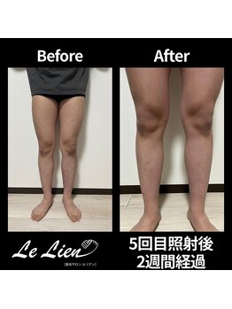 ルリアン(Le Lien)/【メンズ】足症例