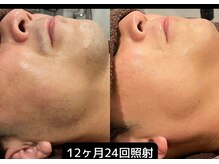 ロワ(Roi)/【肌荒れ改善×顔脱毛】24回施術