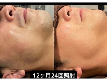 ロワ(Roi)/【肌荒れ改善×顔脱毛】24回施術