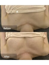 サロンツキ(salon tuki)/【バストアップ】症例★