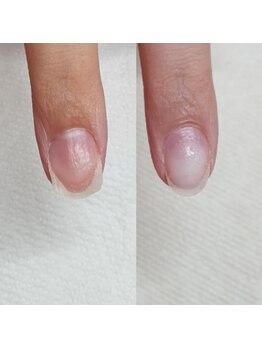 そり爪補正　akane