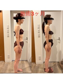 シエル 春日部店(Ciel)/【3ヶ月施術後】