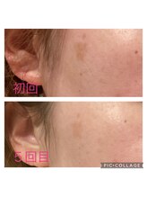 パルティノ 高崎店/シミケア