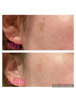 パルティノ 高崎店/シミケア