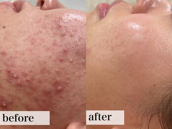 エステサロン ジョアアンジェ(joie ange)/コモデックス/ローズドメーラ1年