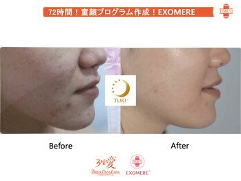 ツキ(TUKI+)/剥けない・ダウンタイム無し