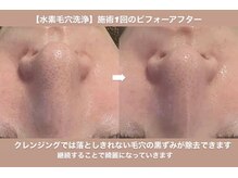 イエナ(IENA)/ニキビケアにも◎全顔丸ごと洗浄