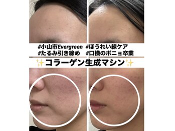 エバーグリーン(Evergreen)/ほいれい線と口横のポニョ肉ケア