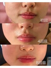 ミルキー(Milky)/マツヤニｘクレイパックで変わる