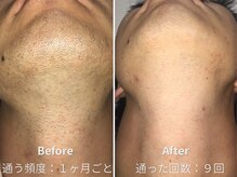リュクスアンドコー 上田店(Luxe&co.)の雰囲気（丁寧な脱毛でしっかり結果が出ます※毛の濃さ密度で個人差有り）