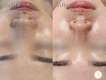 プリュボーテ(Pul Beaute)/毛穴を引き締め素肌に自信を