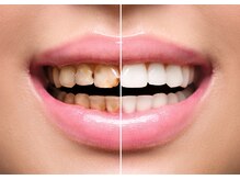 ホワイト 福岡天神店(WHITE)/ホワイトニングで印象アップ♪