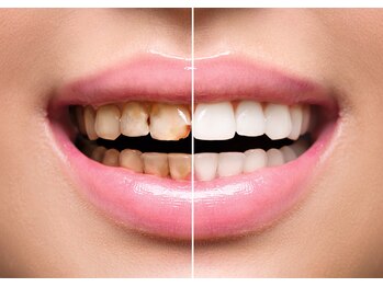 ホワイト 福岡天神店(WHITE)/ホワイトニングで印象アップ♪