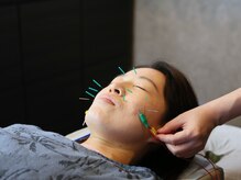 ウルリ(ULULI)/通電で小顔に！立体造顔美容鍼♪