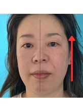 ネクスフィット(Nexfit)/小顔矯正フェイスリフトの効果