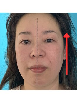 ネクスフィット(Nexfit)/小顔矯正フェイスリフトの効果