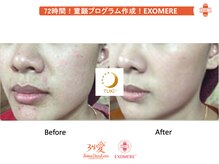 ツキ(TUKI+)/剥けない・ダウンタイム無し