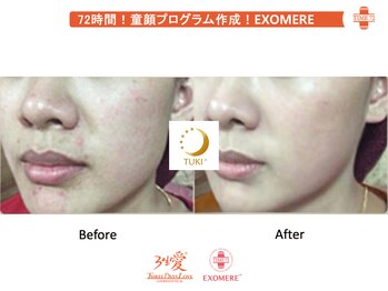 ツキ(TUKI+)/剥けない・ダウンタイム無し