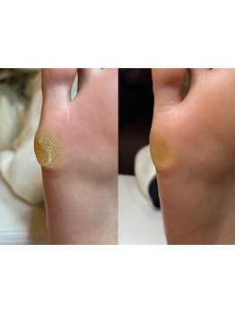 角質ケアができるサロン