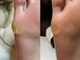 ニーヨンゼロ(240)の写真/定期的な足裏のケア～セルフケアが難しくなった硬い角質まで対応可能！タコ/魚の目/副爪のケアにも◎