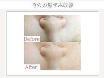 トータルビューティー ゆみえエステ(Total Beauty)/顔脱毛