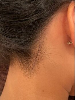 パーツ脱毛のできるサロン