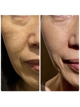 クク 赤坂 天神(99 KUKU)&nbsp;お悩みNo.1 ほうれい線