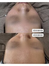 エヌクレアール(Ncrear)/繰り返すことで安定した美肌へ