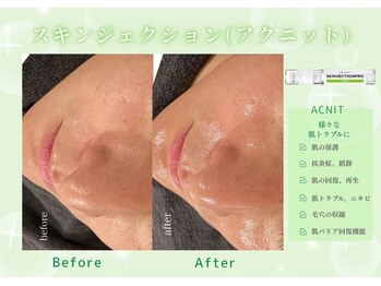 ユアーズ ビューティー(YOURS beauty)/スキンジェクション