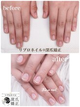 ティアラネイル 宇都宮/リプロネイル深爪矯正コース