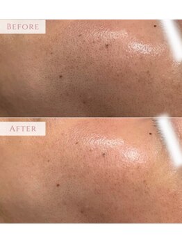 アンドニューリー(&NEWLY)/水素パック&光フェイシャル