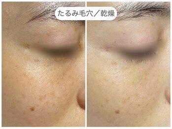 フラックス 京都(FLUX)/【エンビロン】たるみ毛穴コース