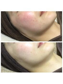 リラーナ(Re rana)/敏感肌