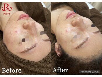 肌質改善専門【Salon da Mahina】毛穴ケア/ニキビケア/ハーブピーリング/ニキビ/ハーブピーリング/藤沢