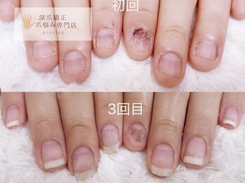 深爪矯正 爪悩み専門店 グラシナ 西宮北口店【4/3 NEW OPEN（予定）】/